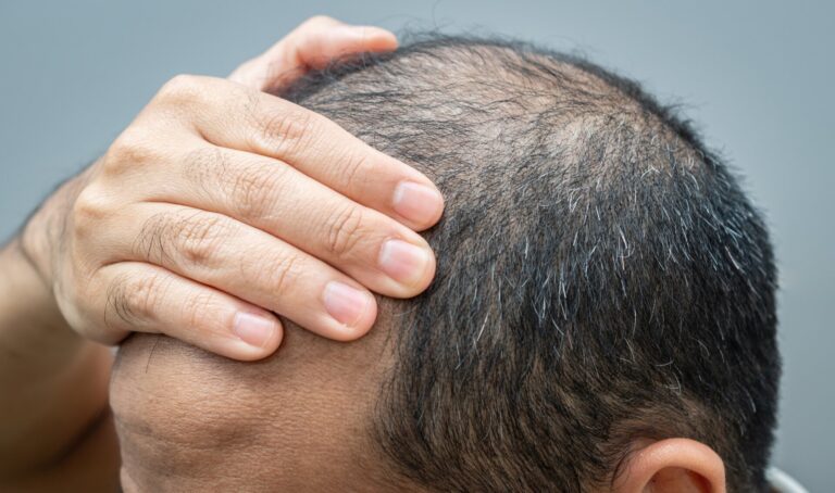 An Off-Label Hair Loss Pill Is Going Mainstream, But Questions Remain